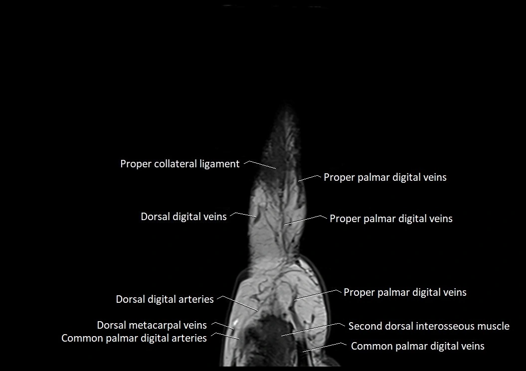 Finger anatomy sagittall cross section 3T image 1.webp